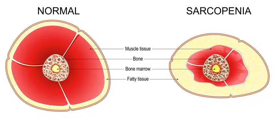 Sarcopenia